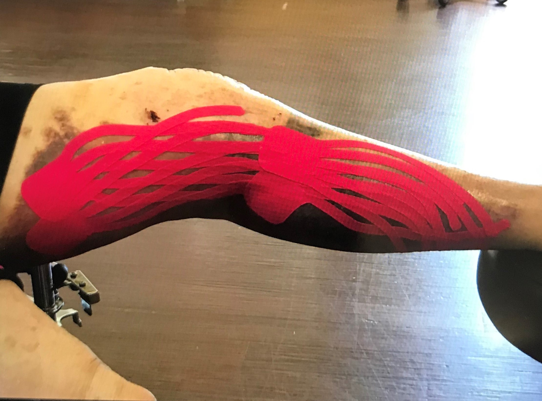 Kinesio Taping to Promote LE Circulation and Lymph Activation